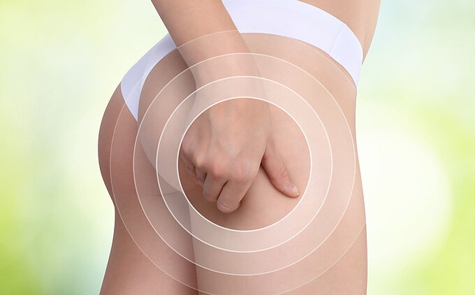 Qué es la Celulitis y cómo combatirla con ejercicio físico