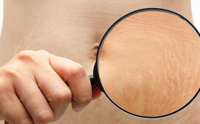 ¿Como evitar las estrias?