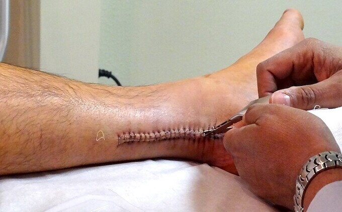 ROTURA DEL TENDON DE AQUILES HACIENDO DEPORTE: COMO RECUPERARSE ROTURA DEL TENDON DE AQUILES HACIENDO DEPORTE: COMO RECUPERARSE