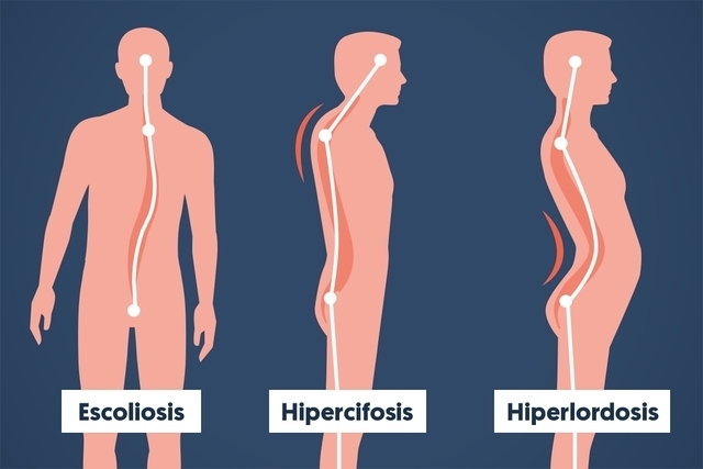 ¿Qué es hiperlordosis?