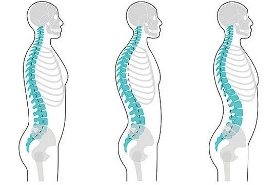 Hiperlordosis