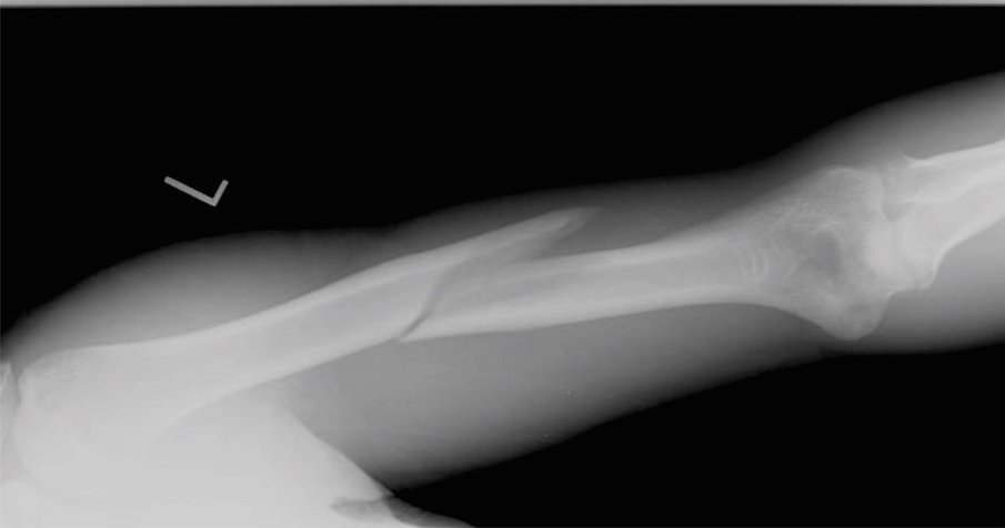 Fracturas óseas