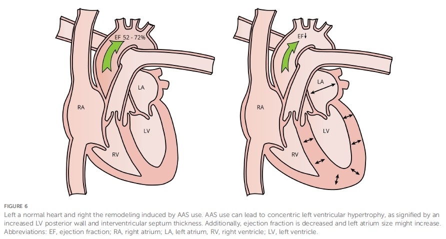 Miocardiopatía y remodelación patológica por anabolizantes