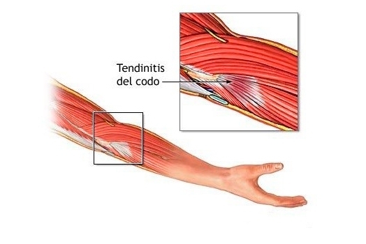 La Temida Tendinitis 5443