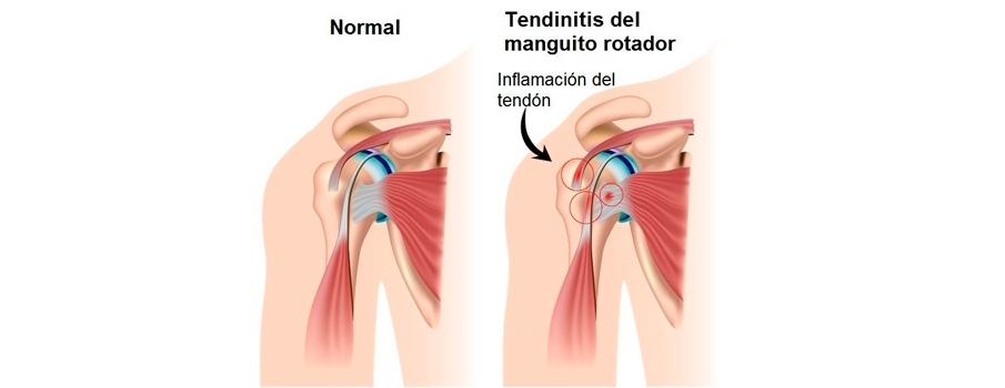 tendinitis de hombro tendinitis del manguito rotador
